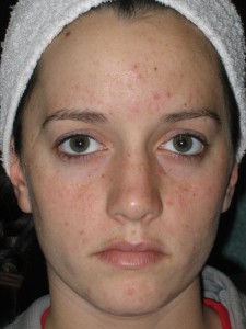 acne before LED