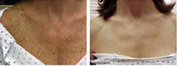 ipl before after
