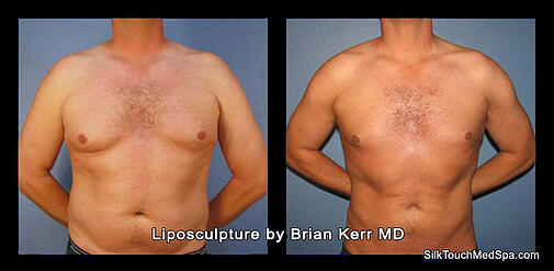10 Pound Weight Loss Before And After Men`s Liposuction Before And After