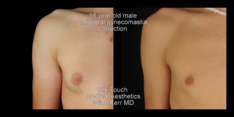 male breast reduction before and after