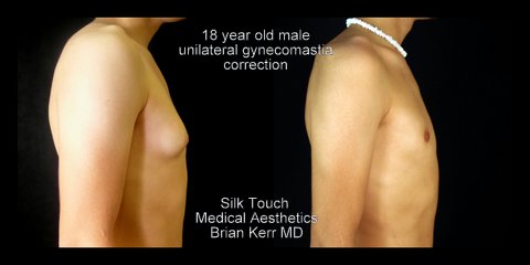 male breast reduction before and after