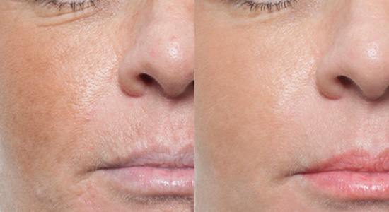 acne scar treatment boise