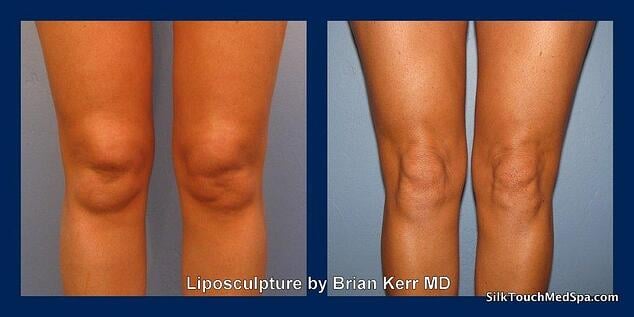 03Liposuction, smartlipo knees and ankles by Brian Kerr MD Boise Idaho 1