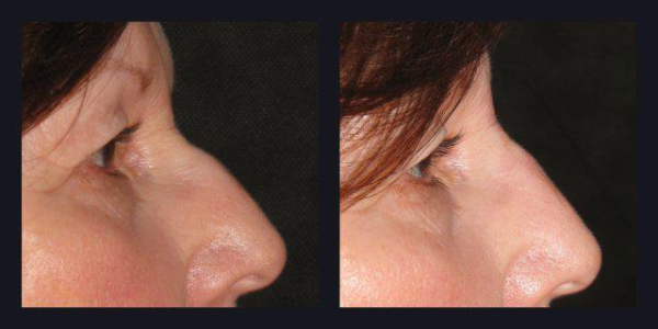 Artefill before and after photos, Artefill rhinoplasty,rhinoplasty non surgical 