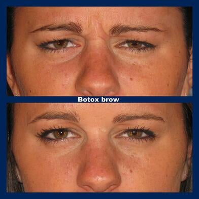 botox brow lift