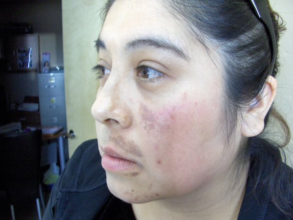 Skin Lightening Peel,before  Silk Touch Med Spa, Boise