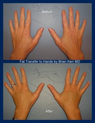 hands, silk touch med spa, fat transfer
