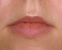 juvederm lip  before photo by Dr. Brian Kerr