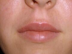 Juvederm lip AFTER by Dr. Brian Kerr
