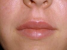 juvederm, silk touch, boise, injectables