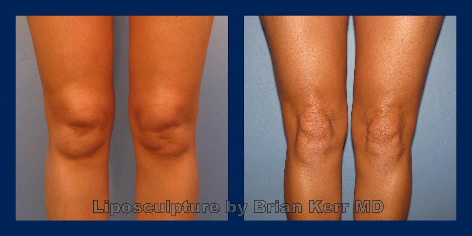 Knee liposuction, smartlipo,vaser, before after, Brian Kerr MD.P,k (2)