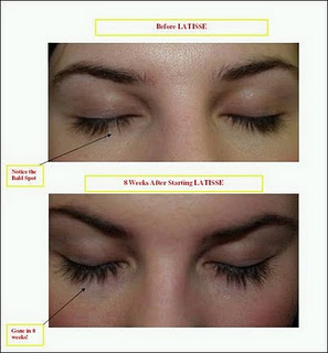 Latisse eyelash enhancement before and after