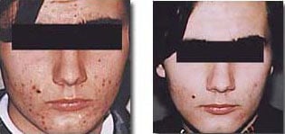 medical microdermabrasion before after silk touch med spa