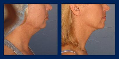 smartlipo neck before and after