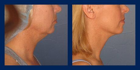 VASER neck liposuction