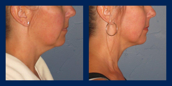 neck liposuction, Silk Touch Med Spa, Boise resized 600