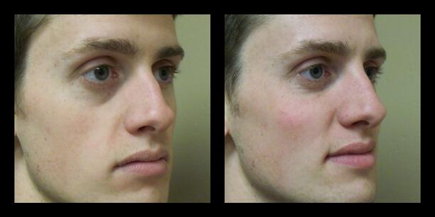 artefill before and after photos, tear trough and nose rhinoplasty