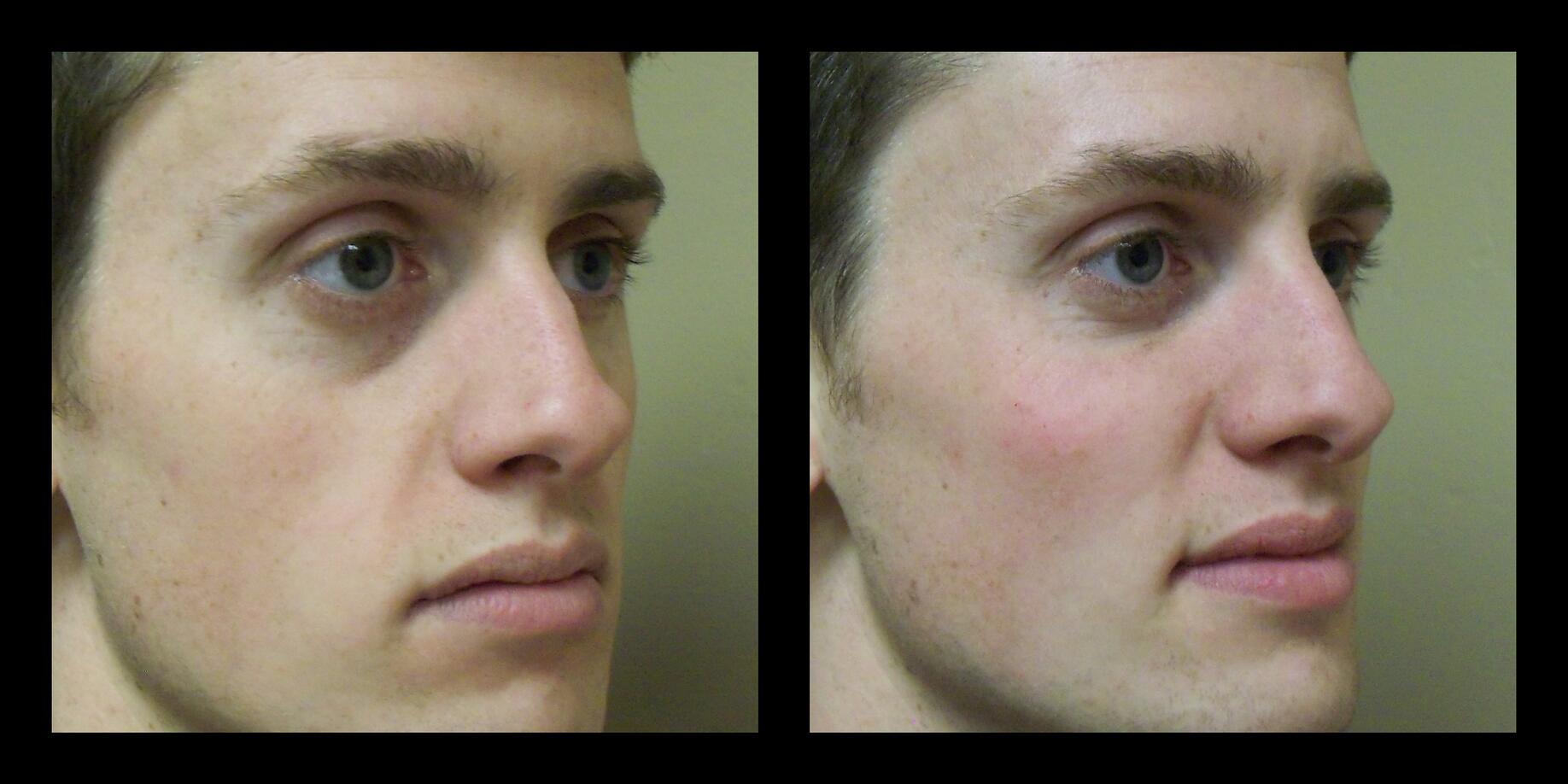 10-minute Nose Job! Non-surgical rhinoplasty!