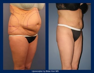 smartlipo before and after