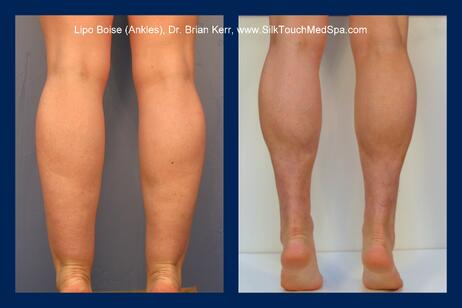 Smartlipo, Vaser, ankle liposuction, Dr. Brian Kerr, Silk Touch Med Spa, Boise