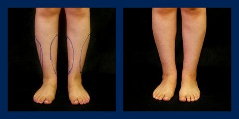 Ankle before and after lipo
