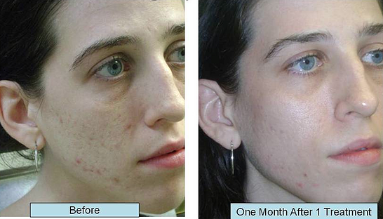 acne scar treatment boise