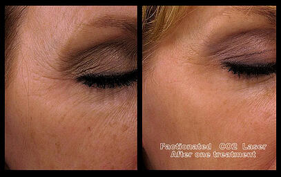 CO2 Fractional Laser Before & After - Glow Aesthetic Medicine