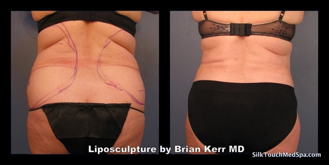 Smartlipo Flanks / Love Handles – Patient 2 Before & After Photos (Women)