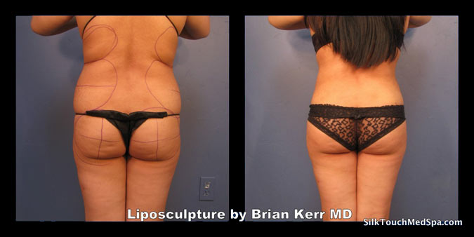 80Liposuction, Smartlipo, Before after Abdomen waist by Brian kerr MD, Boise ID