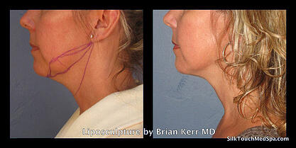 05Liposuction, smartlipo of chin and neck by Brian Kerr MD,  Boise, Idaho