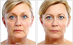 juvederm voluma