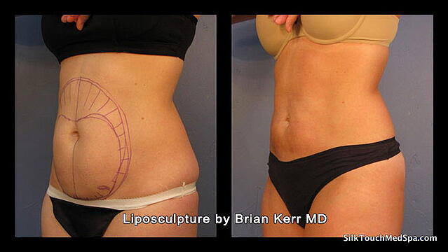 03Liposuction,-Smartlipo,-Before-after-Abdomen-waist-by-Brian-kerr-MD,-Boise-ID.jpg