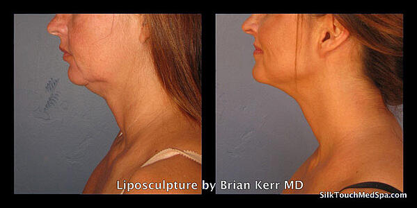 01Liposuction,-smartlipo-of-chin-and-neck-by-Brian-Kerr-MD,--Boise,-Idaho