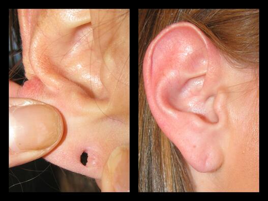 ripped earlobe, earlobe repair boise, before and after silk touch