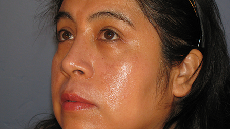 melasma before and after peel