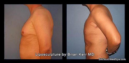 smartlipo chest male before and after