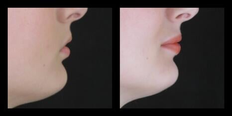 Lip Ehancement Before and After Boise
