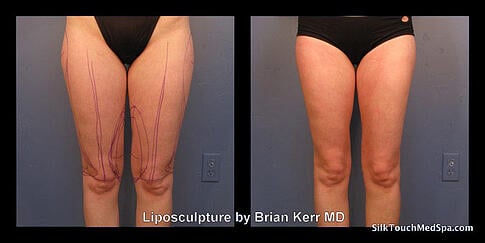 liposuction thighs before and after