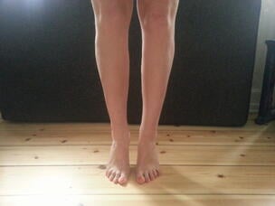 cankle lipo before after pics