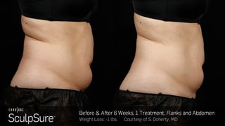 BA-SculpSure-S-Doherty-Post1Tx-6weeks-02.jpg