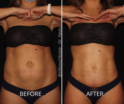 BeforeAfter Tummy Tuck