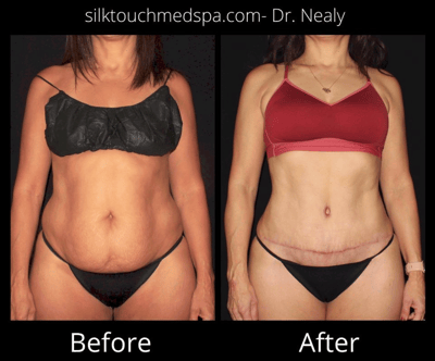 Tummy Tuck Roundup - Dr. Nealy, DO