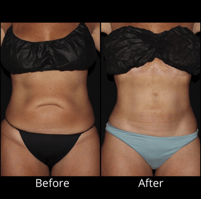 What is a Reverse Tummy Tuck
