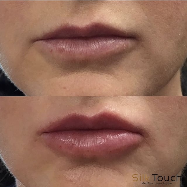 Lip_Filler_before_and_after.jpg