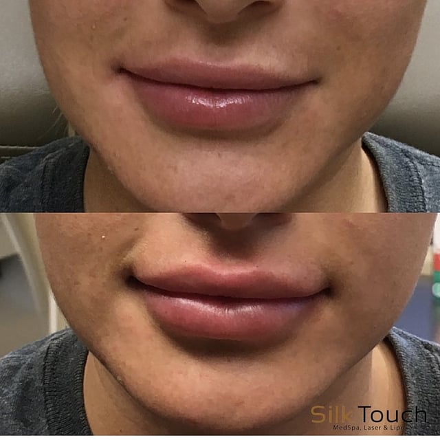 Lip_Filler_before_and_after1.jpg