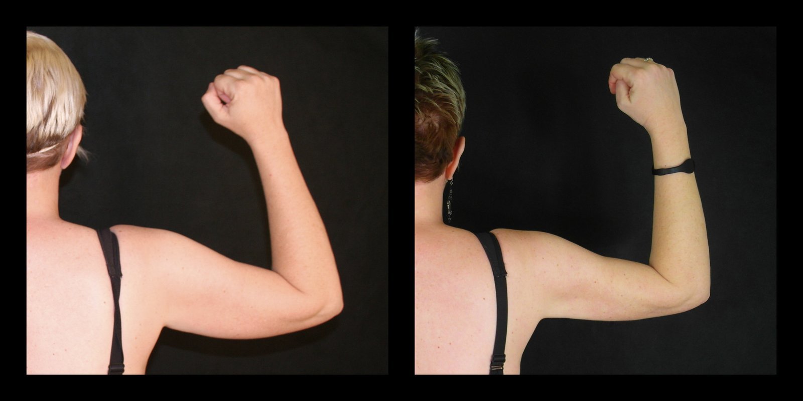 Is Liposuction the Answer to Armpit Fat Removal? - Art Lipo