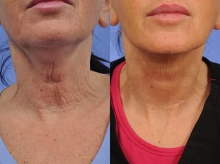 Thermi-Tight-Before-After-Neck-Closeup.jpg