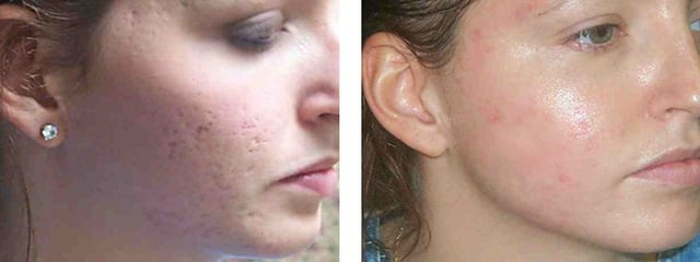 acne-scar-r-face.jpg