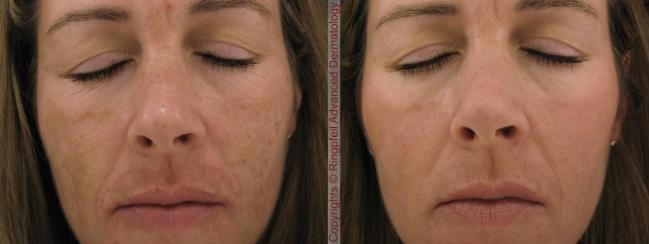 melasma-before-and-after