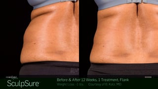 sculpsure-before-after-boise.jpg